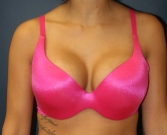 Feel Beautiful - Breast Augmentation San Diego Case 47a - After Photo
